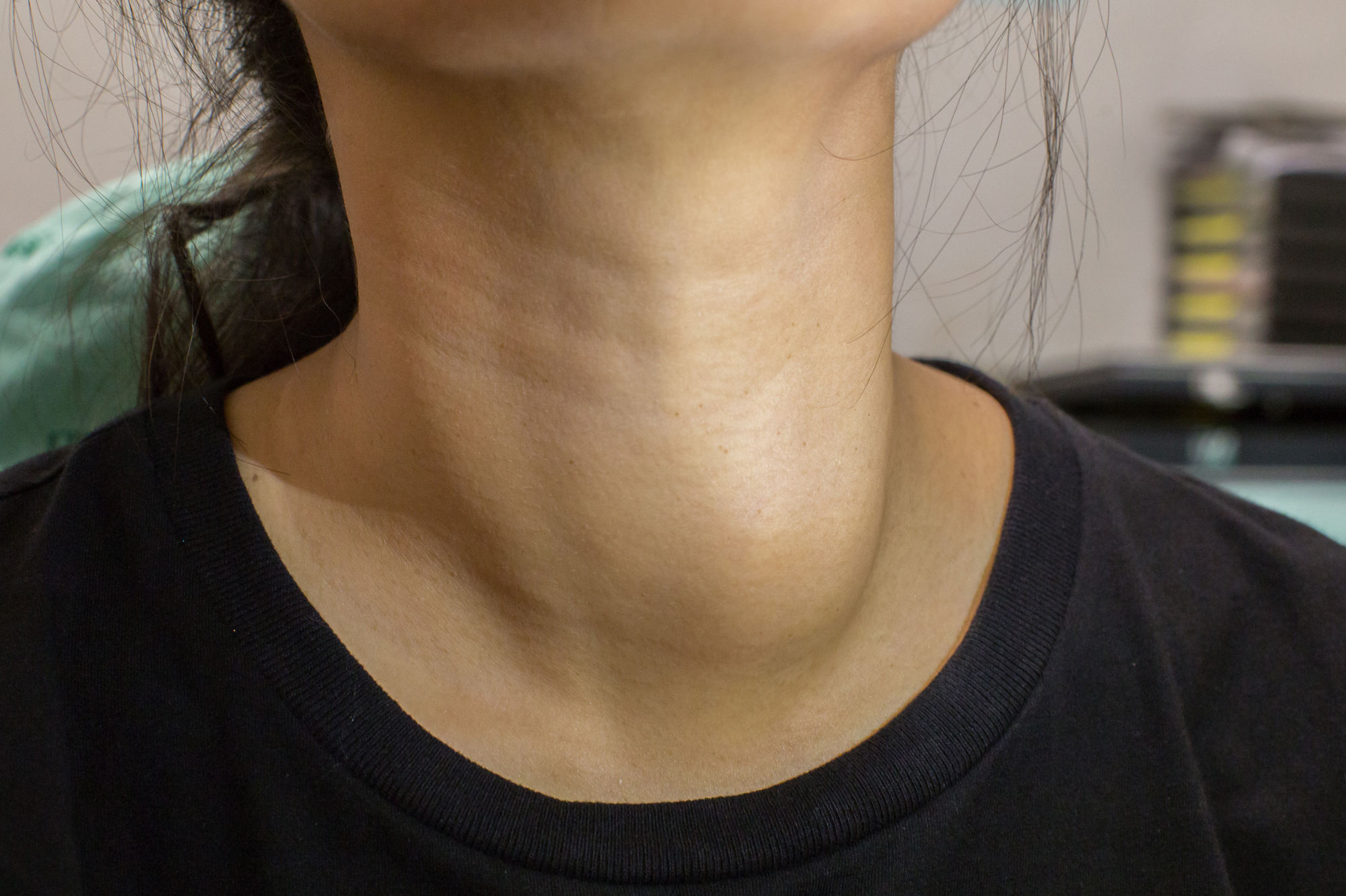 Зоб ахан. Многоузловой зоб щитовидной железы.